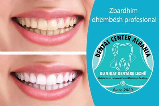 Zbardhim Dhembesh Klinika dentare ne Lezhe  dhe Shengjin / DENTAL CENTER LEZHA